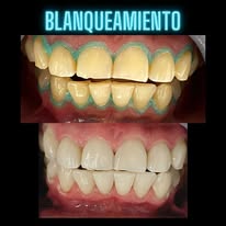 Antes y después blanqueamiento