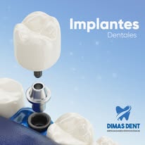 Implantes dentales